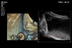 ultrazvucni snimak bebe